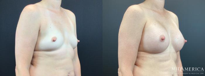 Before & After Breast Augmentation Case 333 Right Oblique View in St. Louis, MO