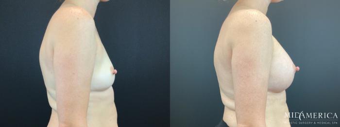 Before & After Breast Augmentation Case 333 Right Side View in St. Louis, MO