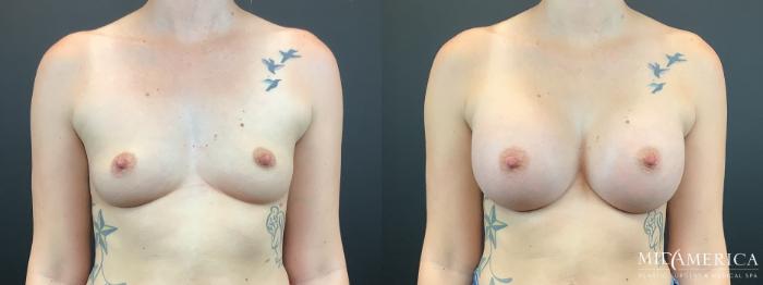 Before & After Breast Augmentation Case 337 Front View in St. Louis, MO