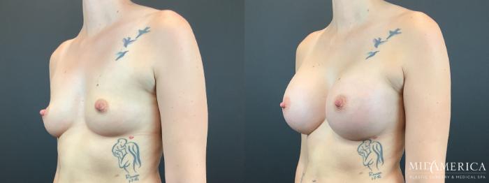 Before & After Breast Augmentation Case 337 Left Oblique View in St. Louis, MO