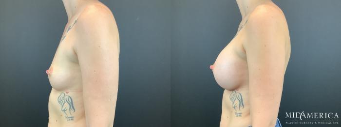Before & After Breast Augmentation Case 337 Left Side View in St. Louis, MO