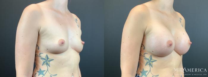 Before & After Breast Augmentation Case 337 Right Oblique View in St. Louis, MO