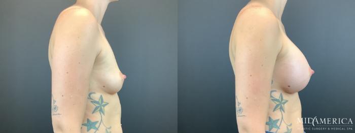 Before & After Breast Augmentation Case 337 Right Side View in St. Louis, MO