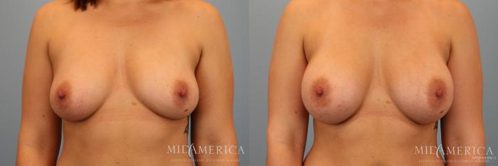 Before & After Breast Augmentation Case 34 View #1 View in St. Louis, MO