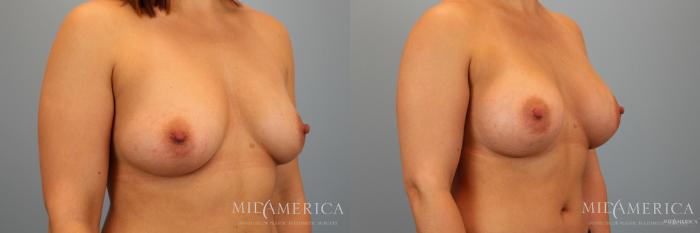 Before & After Breast Augmentation Case 34 View #2 View in St. Louis, MO