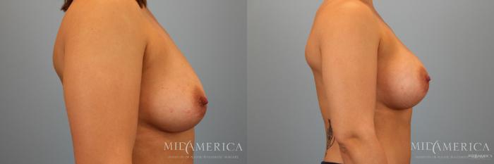 Before & After Breast Augmentation Case 34 View #3 View in St. Louis, MO