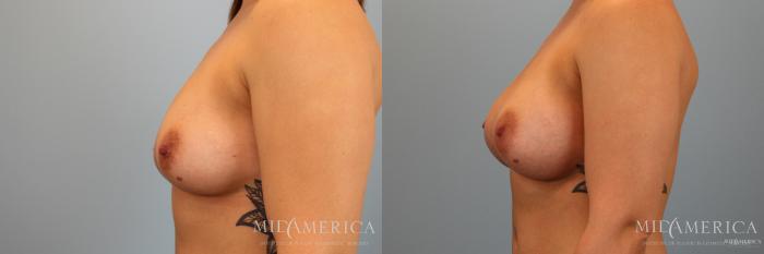 Before & After Breast Augmentation Case 34 View #5 View in St. Louis, MO