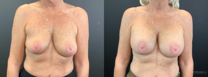 Before & After Breast Augmentation Case 340 Front View in St. Louis, MO