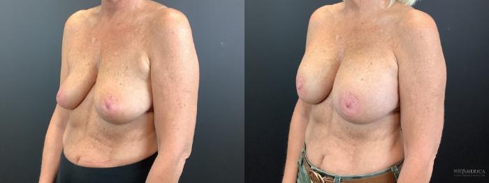 Before & After Breast Augmentation Case 340 Left Oblique View in St. Louis, MO