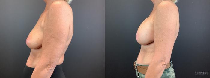 Before & After Breast Augmentation Case 340 Left Side View in St. Louis, MO