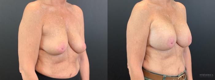 Before & After Breast Augmentation Case 340 Right Oblique View in St. Louis, MO