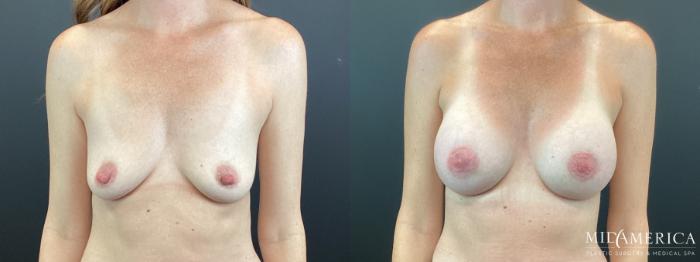 Before & After Breast Augmentation Case 342 Front View in St. Louis, MO