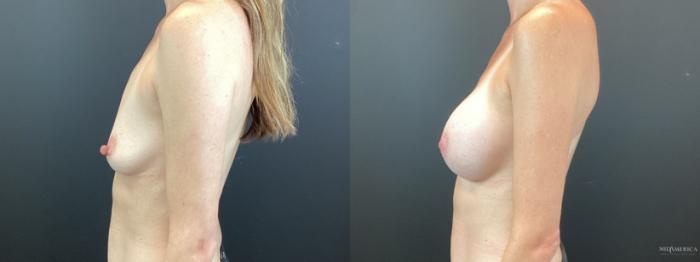 Before & After Breast Augmentation Case 342 Left Side View in St. Louis, MO