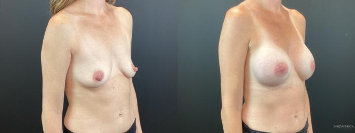 Before & After Breast Augmentation Case 342 Right Oblique View in St. Louis, MO