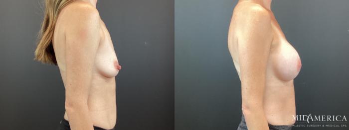Before & After Breast Augmentation Case 342 Right Side View in St. Louis, MO