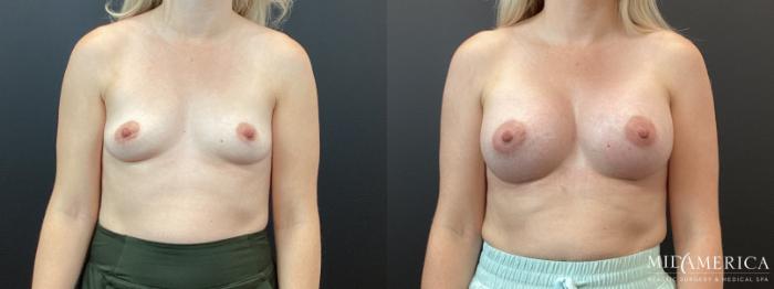 Before & After Breast Augmentation Case 349 Front View in St. Louis, MO