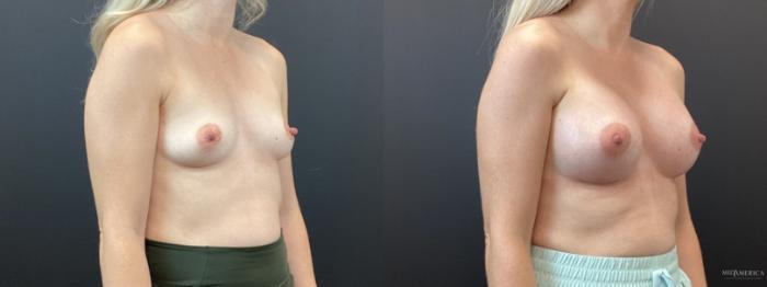 Before & After Breast Augmentation Case 349 Right Oblique View in St. Louis, MO