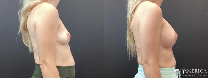 Before & After Breast Augmentation Case 349 Right Side View in St. Louis, MO