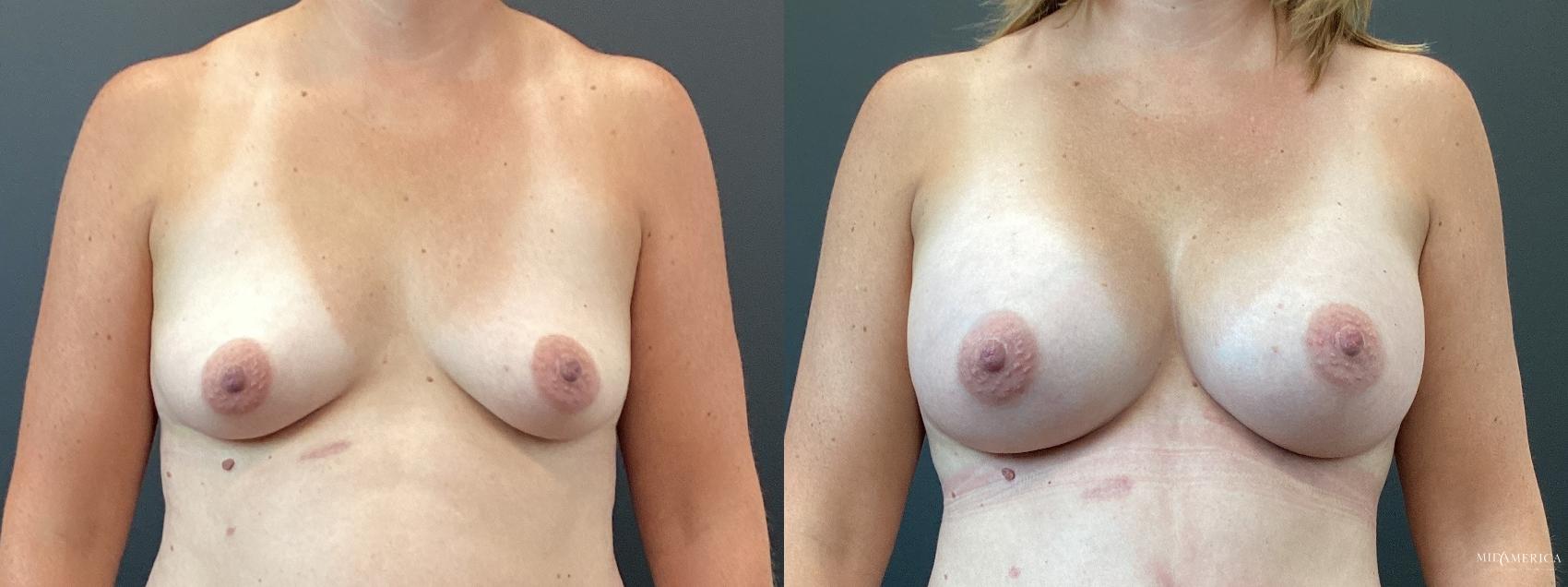 Before & After Breast Augmentation Case 359 Front View in St. Louis, MO