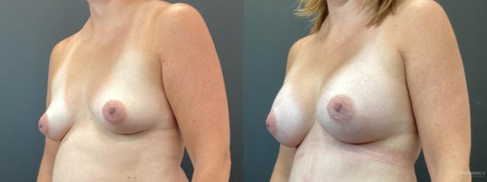 Before & After Breast Augmentation Case 359 Left Oblique View in St. Louis, MO