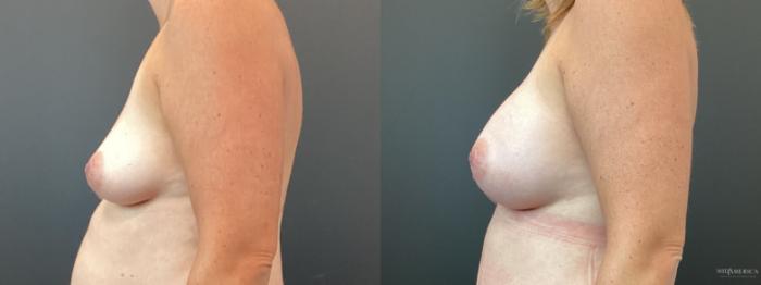 Before & After Breast Augmentation Case 359 Left Side View in St. Louis, MO