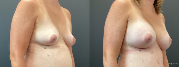 Before & After Breast Augmentation Case 359 Right Oblique View in St. Louis, MO