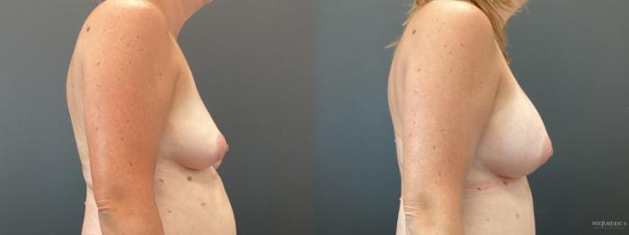 Before & After Breast Augmentation Case 359 Right Side View in St. Louis, MO