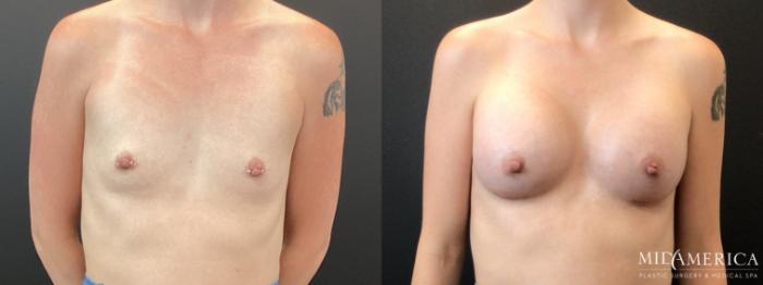 Before & After Breast Augmentation Case 367 Front View in St. Louis, MO