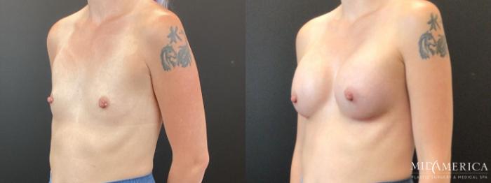 Before & After Breast Augmentation Case 367 Left Oblique View in St. Louis, MO