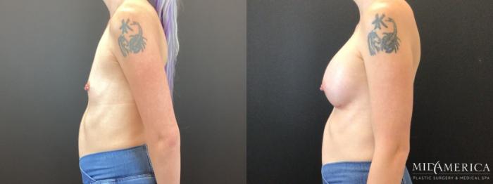 Before & After Breast Augmentation Case 367 Left Side View in St. Louis, MO
