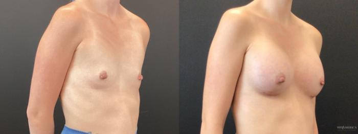 Before & After Breast Augmentation Case 367 Right Oblique View in St. Louis, MO