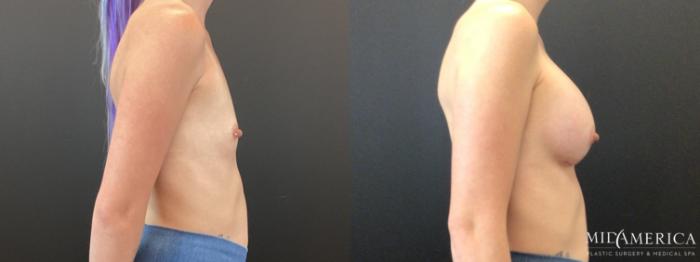 Before & After Breast Augmentation Case 367 Right Side View in St. Louis, MO