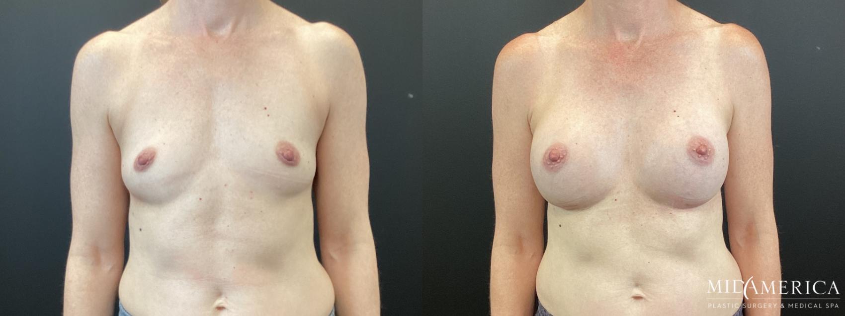 Before & After Breast Augmentation Case 370 Front View in St. Louis, MO