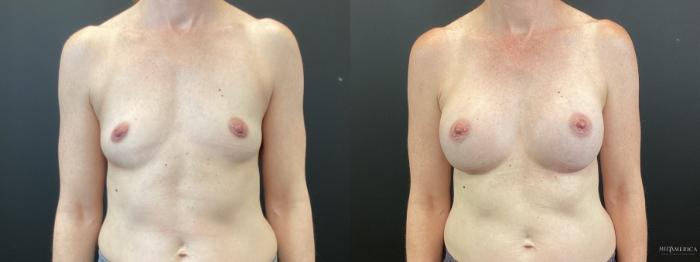 Before & After Breast Augmentation Case 370 Front View in St. Louis, MO