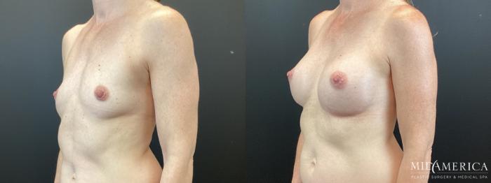 Before & After Breast Augmentation Case 370 Left Oblique View in St. Louis, MO