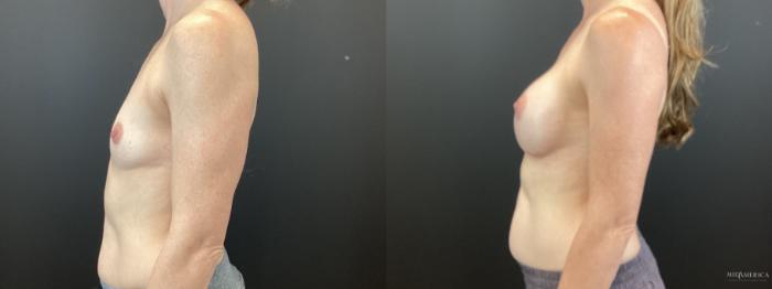 Before & After Breast Augmentation Case 370 Left Side View in St. Louis, MO