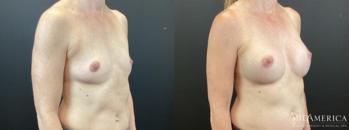 Before & After Breast Augmentation Case 370 Right Oblique View in St. Louis, MO