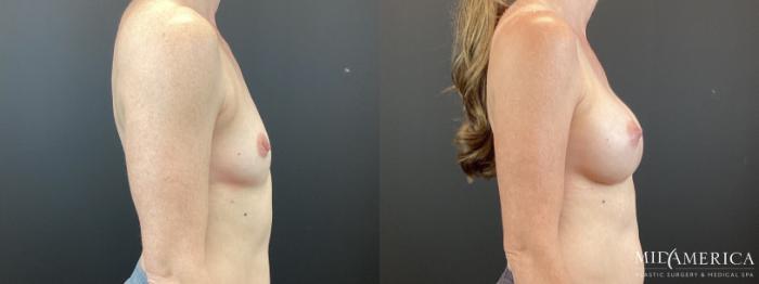 Before & After Breast Augmentation Case 370 Right Side View in St. Louis, MO