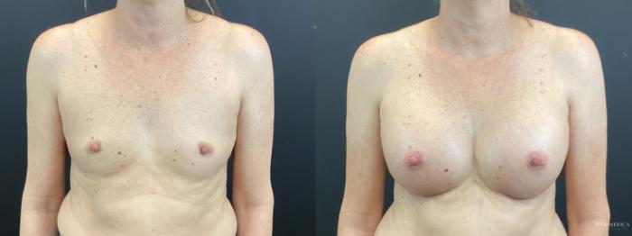 Before & After Breast Augmentation Case 371 Front View in St. Louis, MO