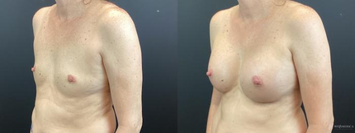 Before & After Breast Augmentation Case 371 Left Oblique View in St. Louis, MO
