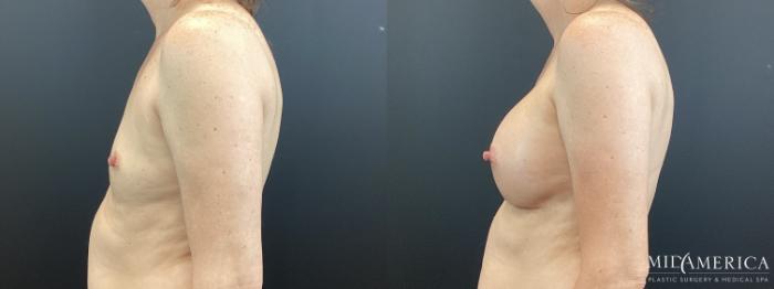 Before & After Breast Augmentation Case 371 Left Side View in St. Louis, MO
