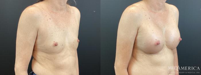 Before & After Breast Augmentation Case 371 Right Oblique View in St. Louis, MO