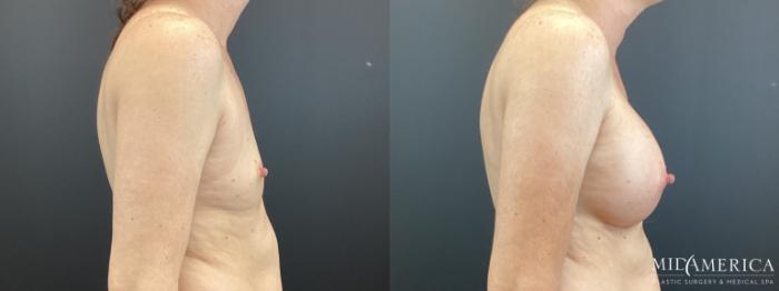 Before & After Breast Augmentation Case 371 Right Side View in St. Louis, MO