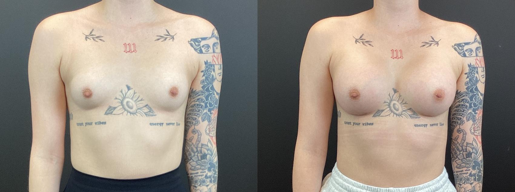 Before & After Breast Augmentation Case 373 Front View in St. Louis, MO