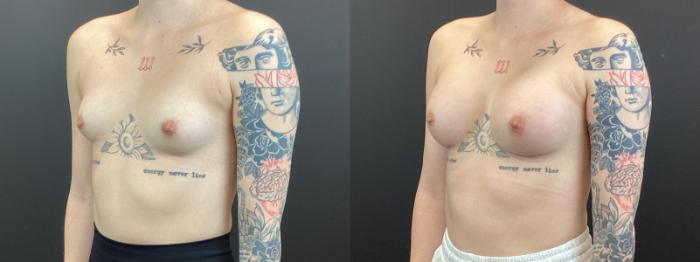 Before & After Breast Augmentation Case 373 Left Oblique View in St. Louis, MO