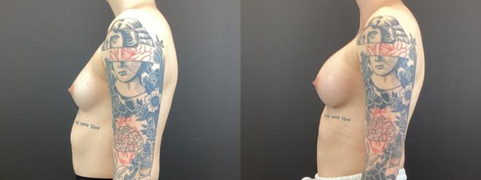 Before & After Breast Augmentation Case 373 Left Side View in St. Louis, MO