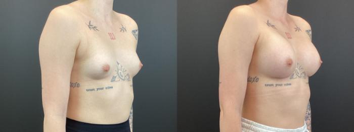 Before & After Breast Augmentation Case 373 Right Oblique View in St. Louis, MO