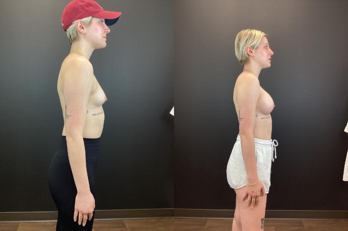 Before & After Breast Augmentation Case 373 Right Side View in St. Louis, MO