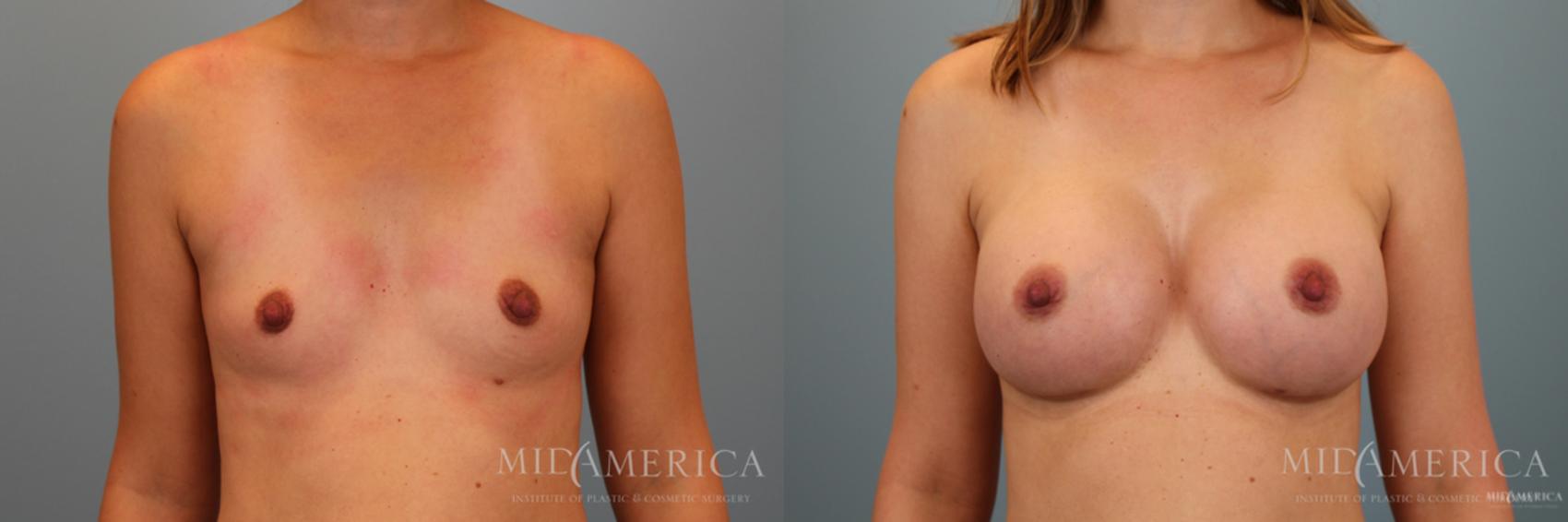 Before & After Breast Augmentation Case 39 View #1 View in Glen Carbon, IL
