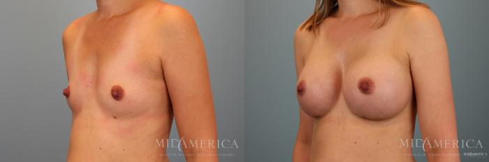 Before & After Breast Augmentation Case 39 View #2 View in Glen Carbon, IL